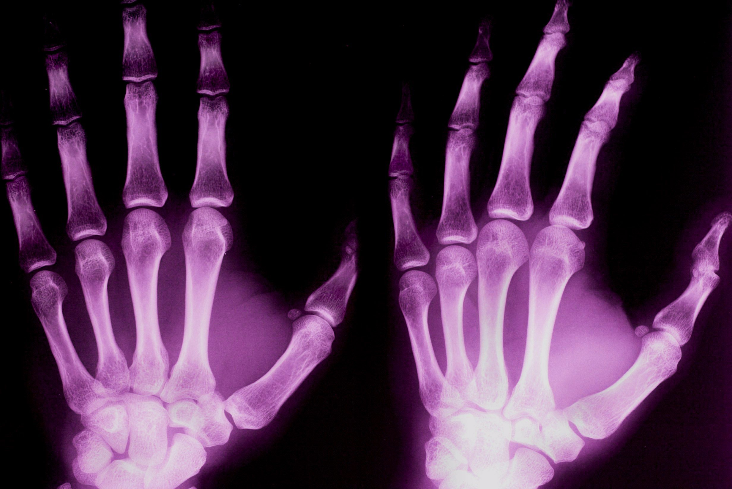 Yksi Kaatuminen Riitt Osteoporoosi Vie Toimintakyvyn Verkkouutiset