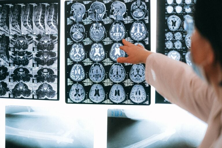 Alzheimerin hoito voisi tulevaisuudessa siirtyä yhä aikaisempaan vaiheeseen. / Anna Shvets